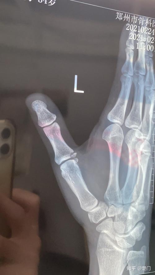 小萨遭遇拇指韧带撕脱性骨折